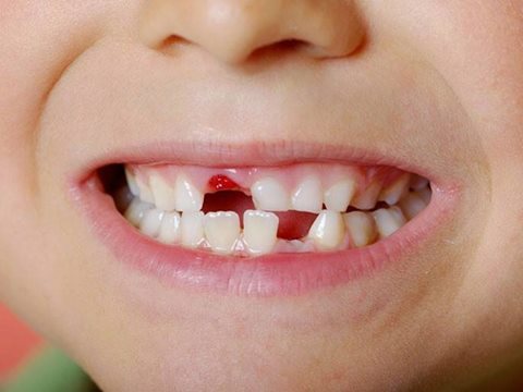 كيفية التعامل مع اصابات الاسنان سواء الدائمة او اللبنية - STJEGYPT